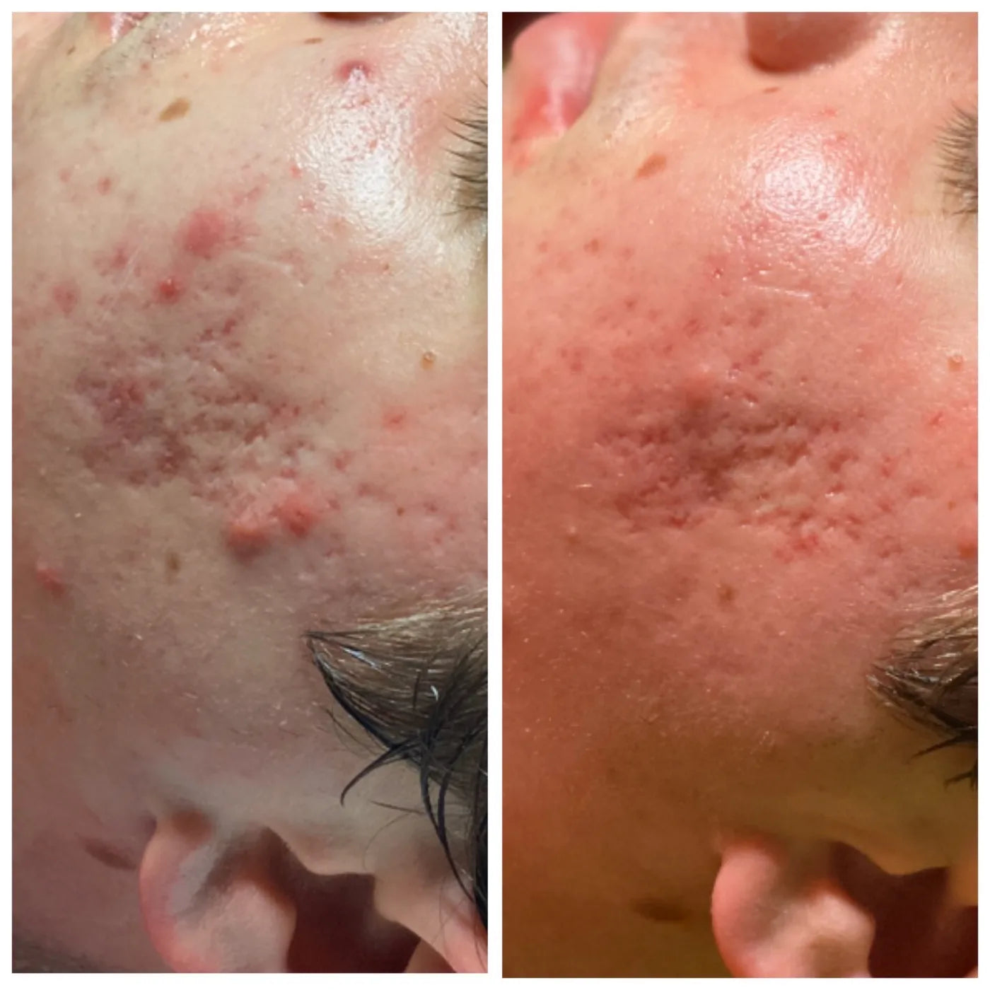 Close-up before-and-after comparison showing visible acne and texture changes