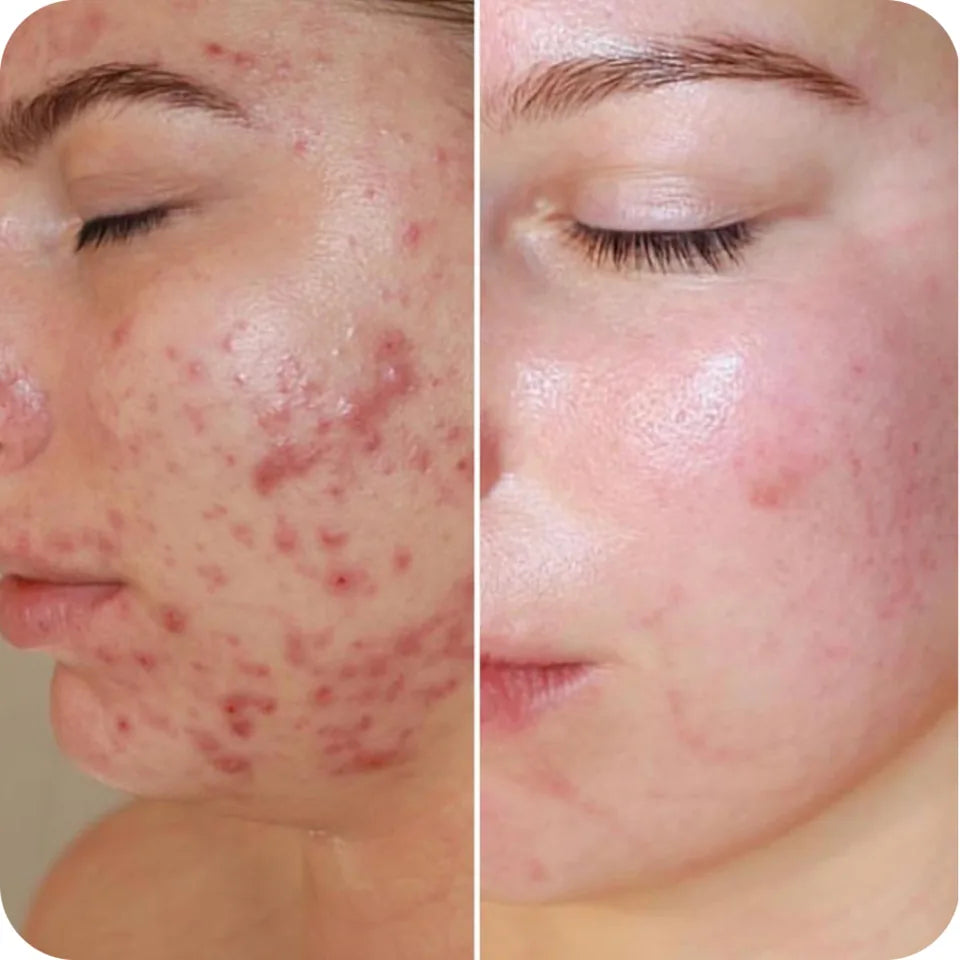 Before-and-after cheek comparison showing visible reduction in acne and post-breakout redness
