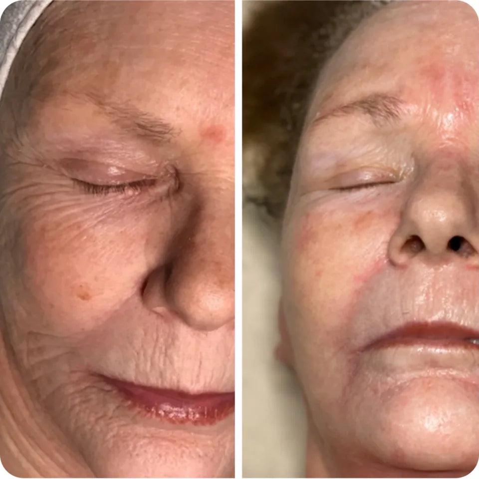 Before-and-after facial comparison showing visible softening of fine lines and improved overall skin tone