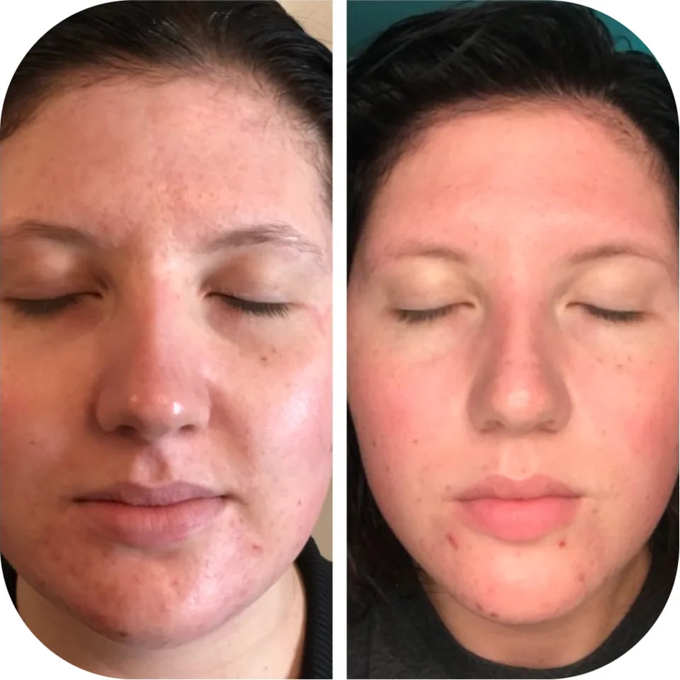 Before-and-after facial comparison showing calmer, more balanced-looking skin