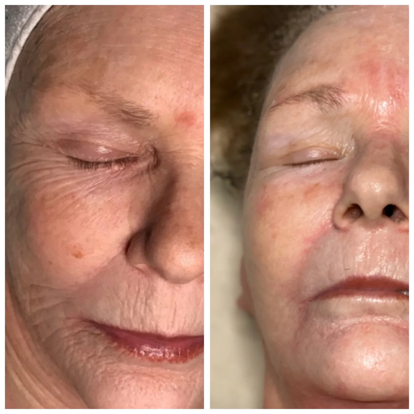 Before-and-after comparison focused on visible smoothing around the eye area