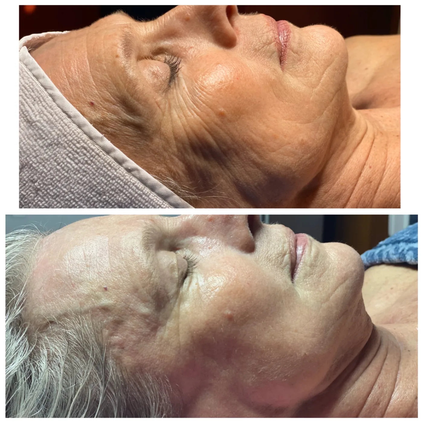 Side-profile before-and-after comparison showing visible firmness and texture changes