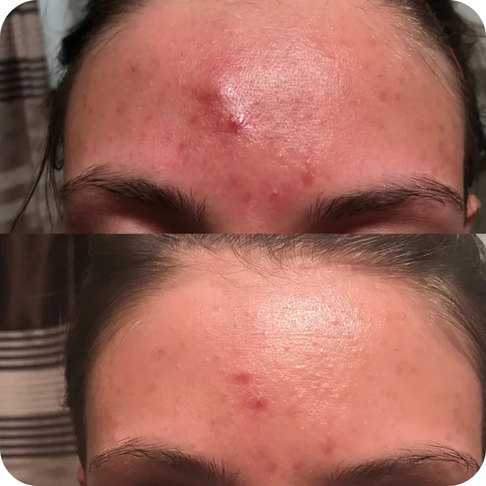 Before-and-after forehead comparison showing visible calming of redness and inflammation
