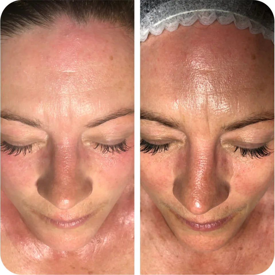 Before-and-after facial comparison showing visible brightening and surface renewal