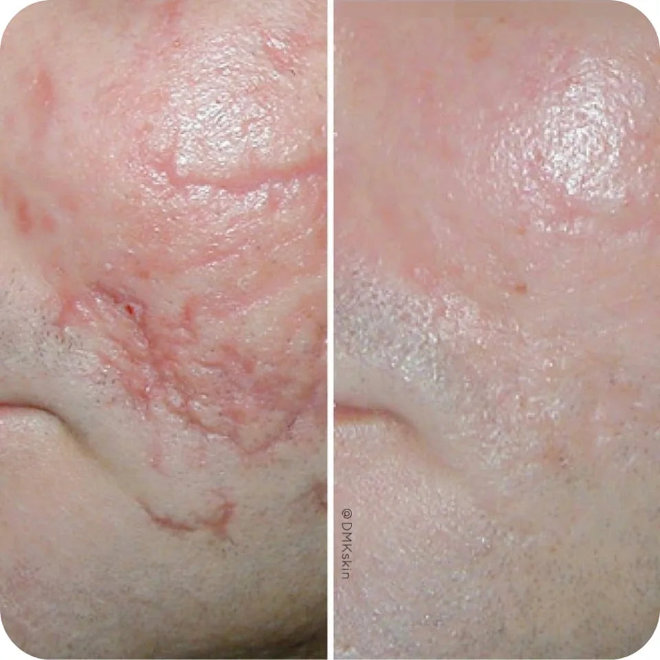 Before-and-after cheek detail showing visible softening of scar texture and redness