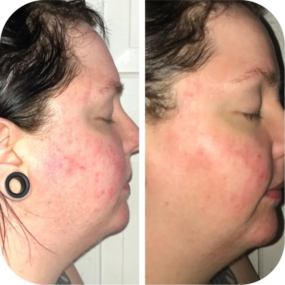 Before-and-after side-profile comparison showing visible reduction in cheek redness