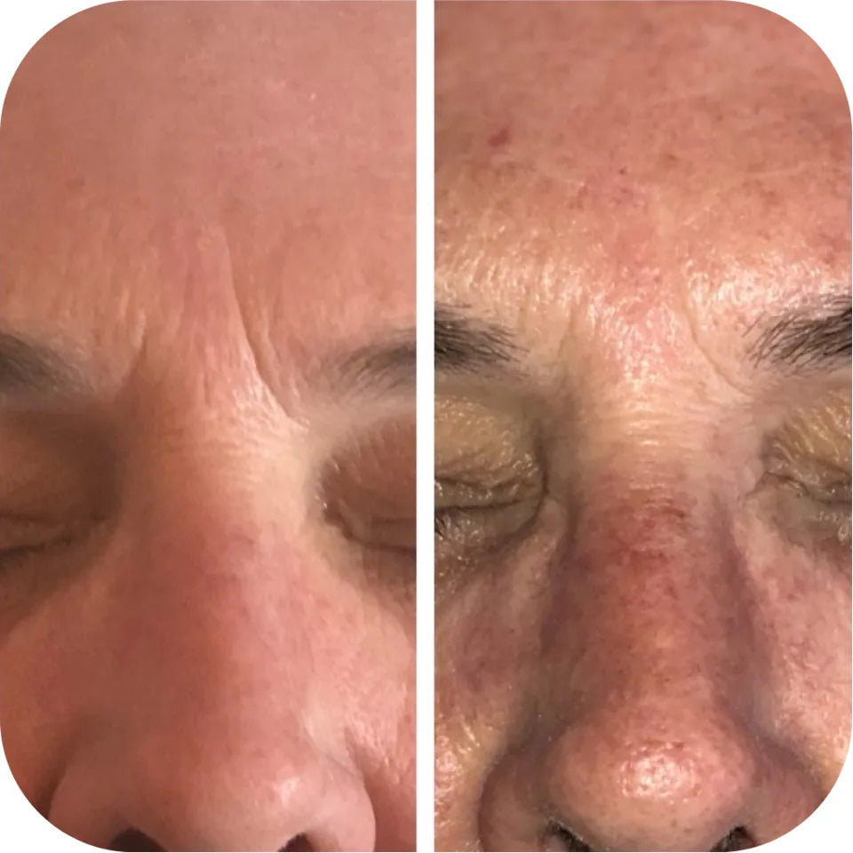 Before-and-after forehead comparison showing visible refinement in skin texture