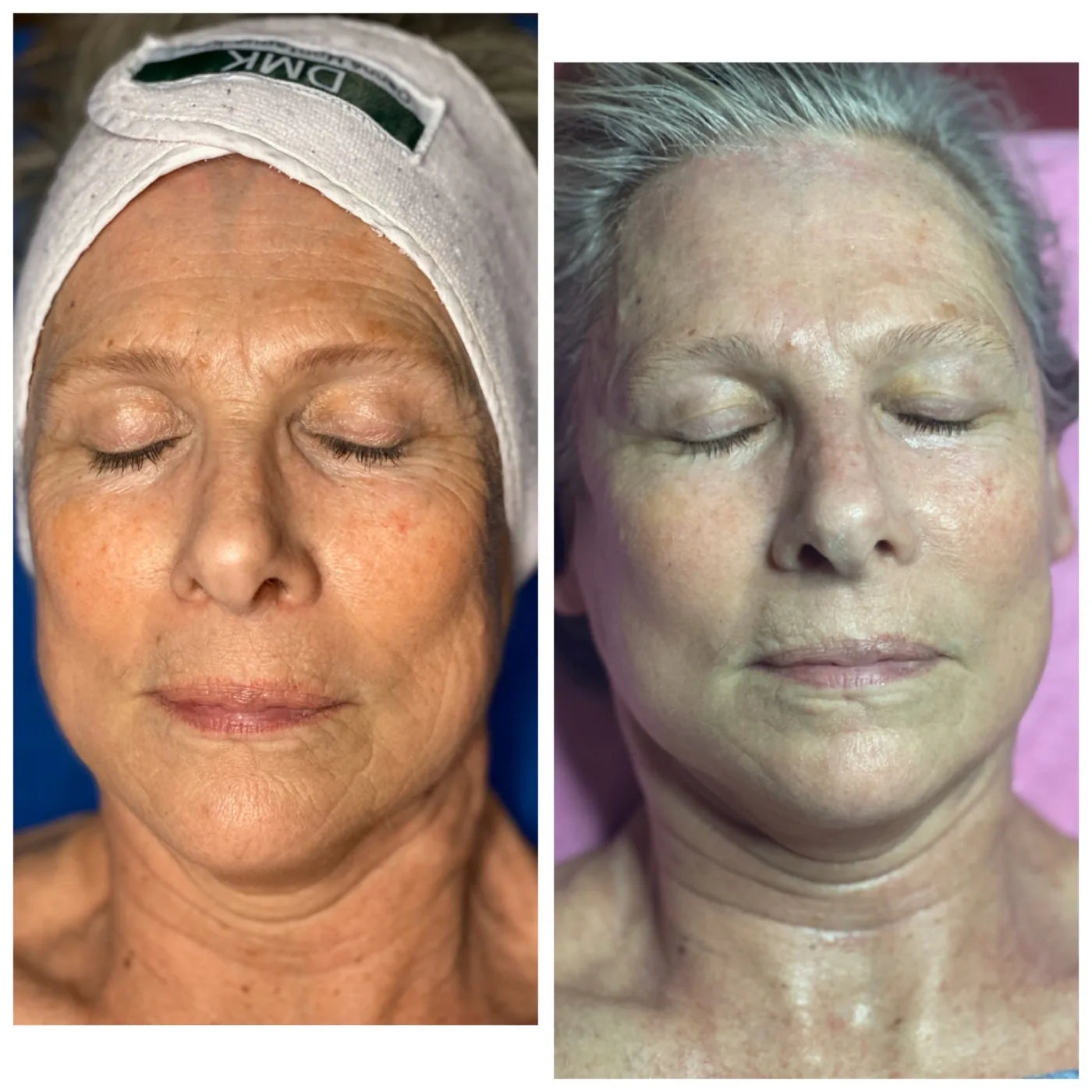 Front-facing before-and-after comparison showing visible tone and clarity changes